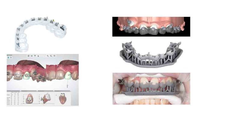 clear aligners 3D printed