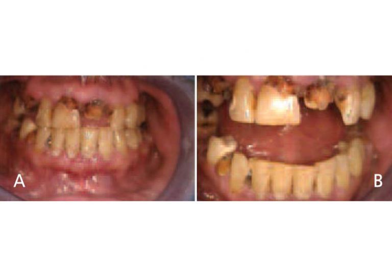 meth before and after pictures teeth
