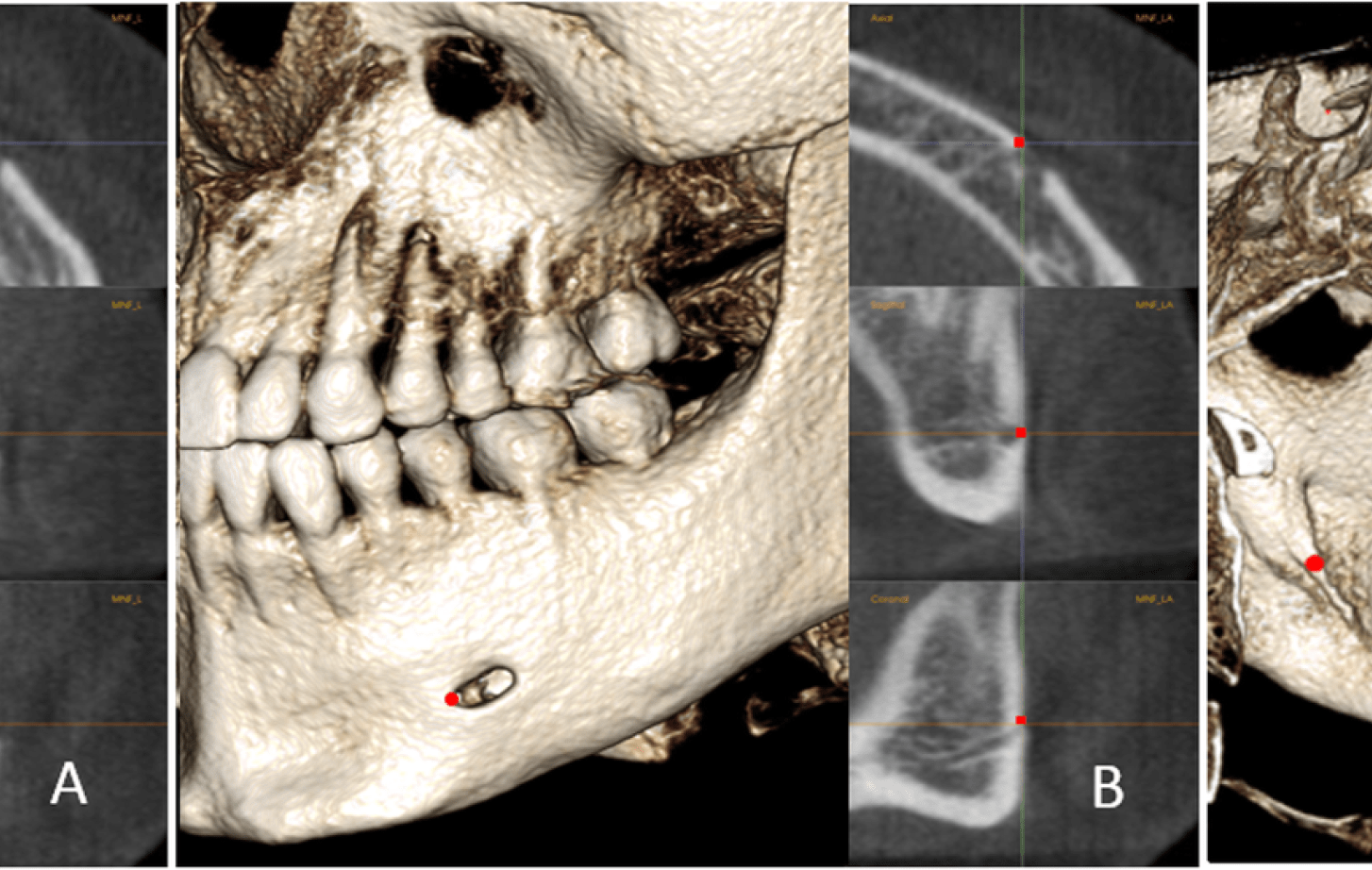 The positions of MF, MFA, and MdF on the left side: a, MF is located in center of the mental foramen; b, MFA is the most anterior point of the mental foramen; c, MdF is located in the center of the mandibular foramen. It is placed on the first slice where the canal shows a complete circle from superior to inferior