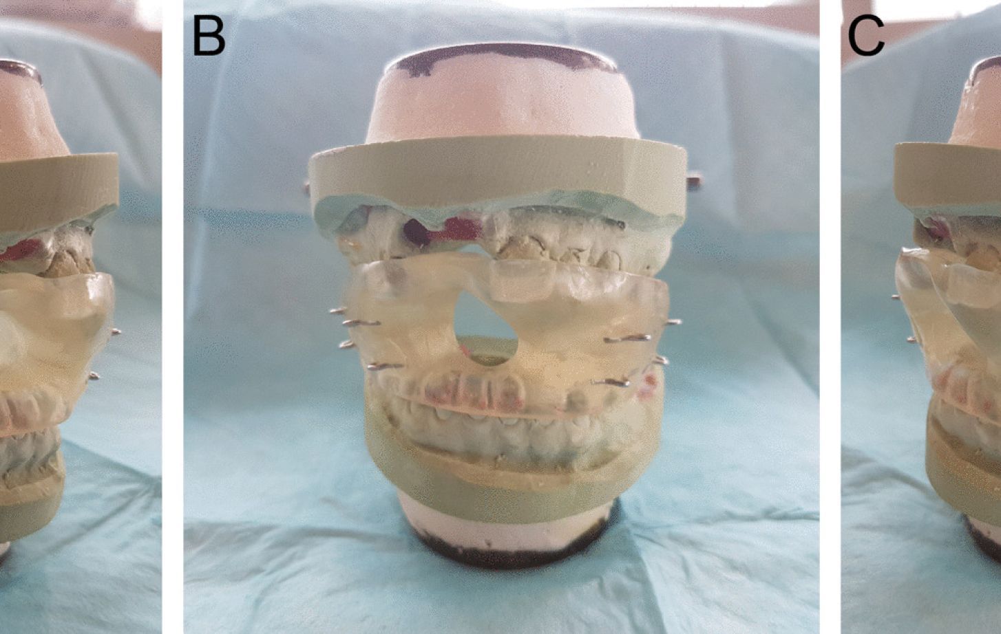 oral appliance