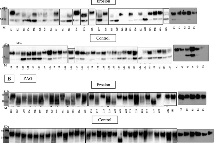 Caption: Immunoblots for (A) PIP and (B) ZAG proteins identified in saliva samples (E = erosion, H = healthy controls, M = protein marker)