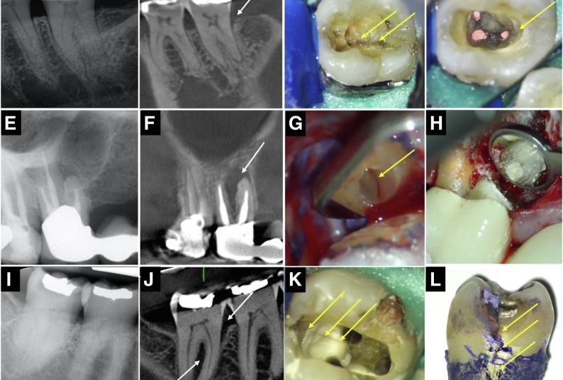 Radiographic presentation of teeth with clinical evidence of longitudinal fractures. (A–D) An angular defect associated with a cracked tooth. (E–H) A J-shaped lesion associated with VRF. 