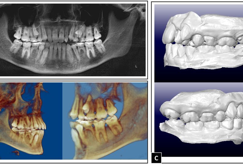 Fig. 1. Example of patient's digital records. (A) Panoramic image; (B) Cone beam computed tomography 3D rendering; (C) Digital dental model from an intraoral scanner.