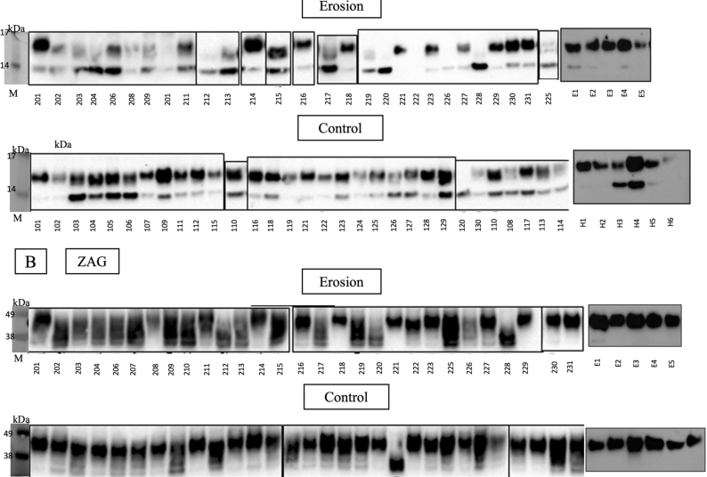Caption: Immunoblots for (A) PIP and (B) ZAG proteins identified in saliva samples (E = erosion, H = healthy controls, M = protein marker)